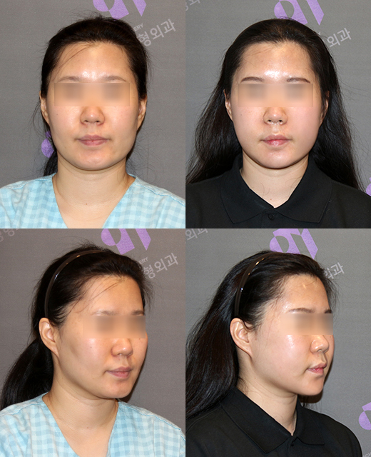 광대수술과 볼패임 교정을 같이 할 수 있나요? 관련 이미지 6