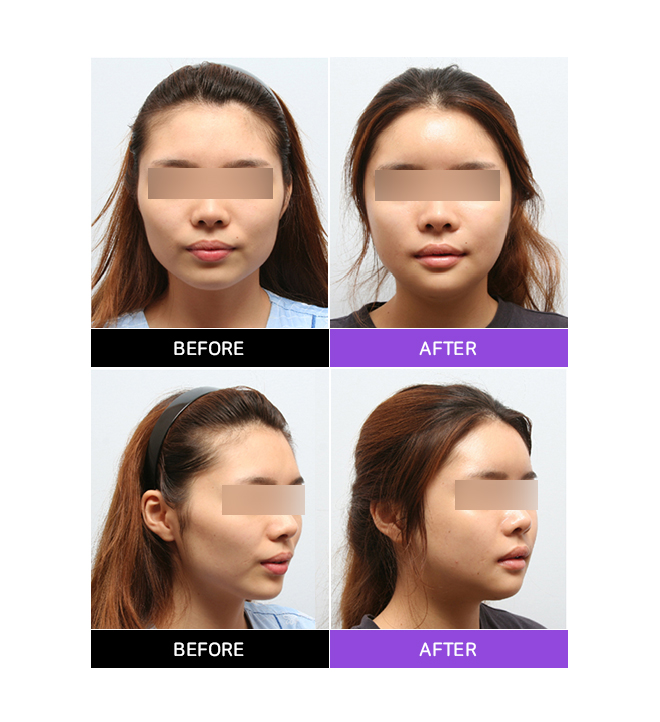 Sunken Cheeks!? It’s Not a Side Effect of Zygoma Surgery! image 8