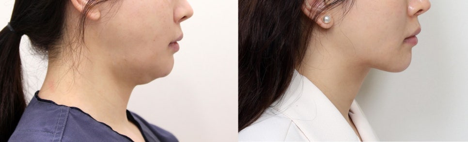 얼굴 작아지는 수술 & 시술 TOP 3 - 어떤 방법이 가장 효과적일까? 관련 이미지 5