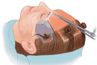 내시경 이마거상술 수술방법과 60대 환자의 놀라운 변화 관련 이미지 2