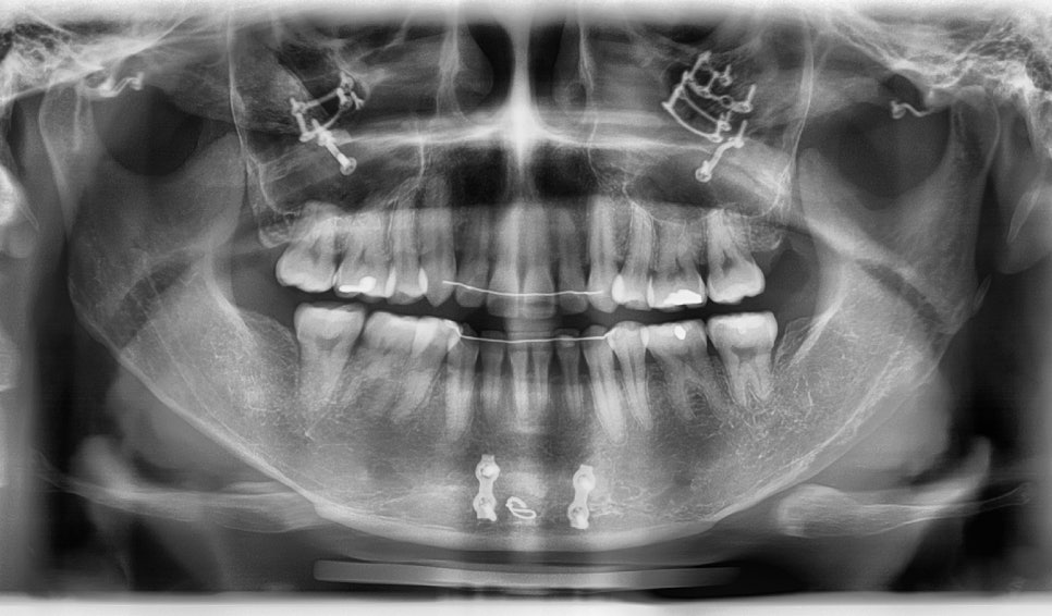 After Facial Contouring Surgery: Asymmetry, When Can Revision Surgery Be Performed? image 9