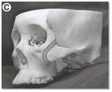 Why Are There So Many Methods for Cheekbone Surgery? A Look at Osteotomy Methods image 4