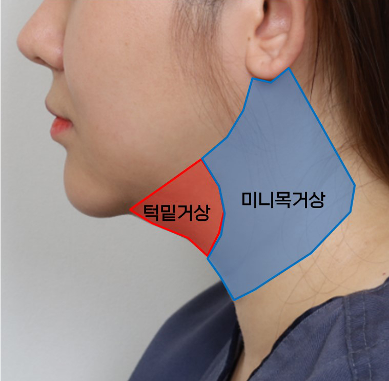 이중턱-턱선 수술의 진화 : 3단계 조합의 비밀 관련 이미지 4