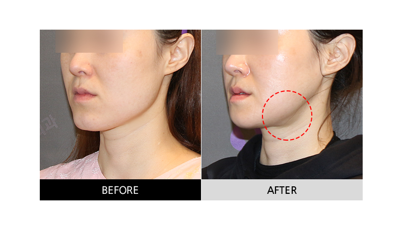 Side Effects After Facial Contouring (Square Jaw, Chin Tip) Surgery: Double Chin and Salivary Gland Enlargement image 5