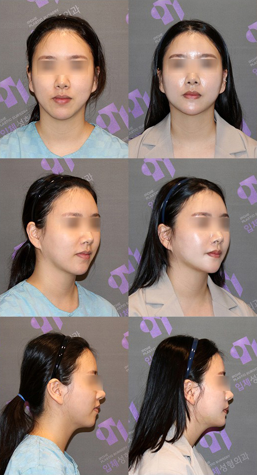 Can Chin Advancement Surgery Adjust Chin Length? image 6