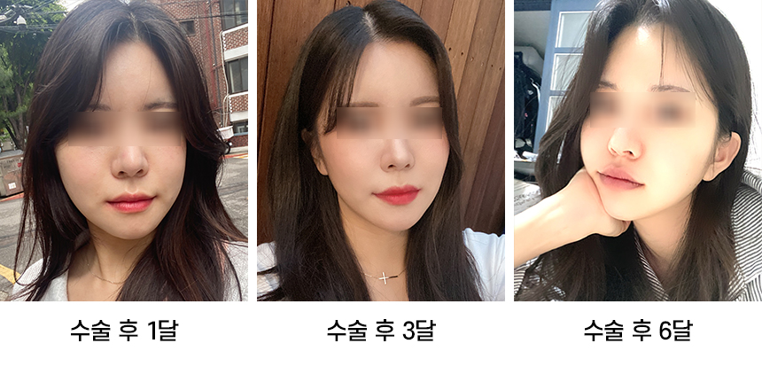 Do Not Confuse Facial Contouring Sagging with Swelling! image 4