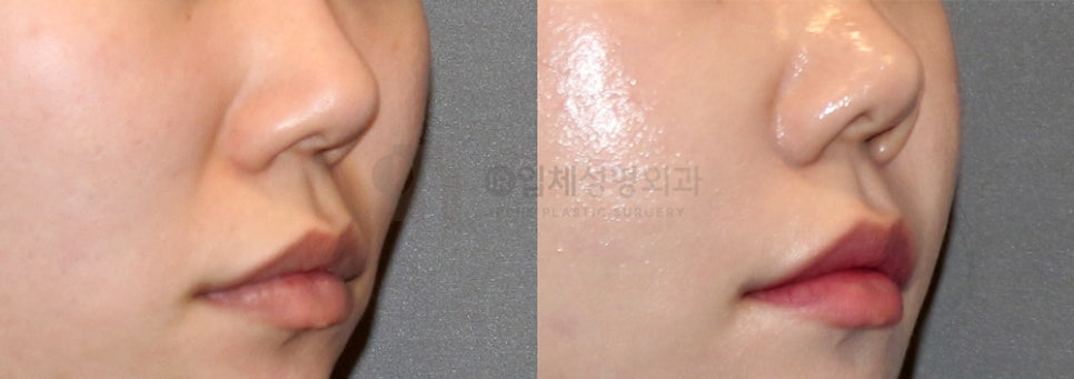 How Can a Sunken Midface Be Corrected? image 5