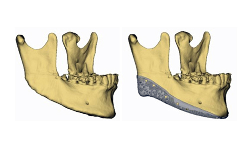 Jaw Contour Surgery: Why Is Revision Surgery Performed? image 9