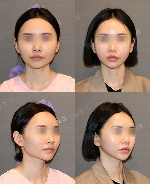 A Complete Summary of 6 Complications After Cheekbone Surgery: Sinusitis, Recurrence, Hollow Cheeks, and Sagging Cheeks image 3