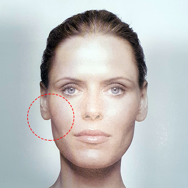 Sunken Cheeks!? It’s Not a Side Effect of Zygoma Surgery! image 1