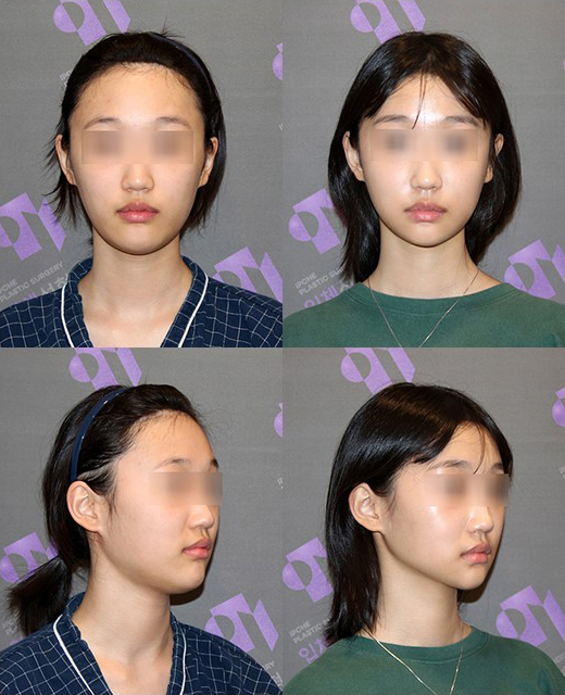 After cheekbone reduction surgery, is there still a back cheekbone left? Is there a solution? image 7