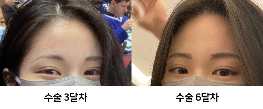 Endoscopic Forehead Lift Swelling and Recovery Time: Looking at It with Before-and-After Photos image 8