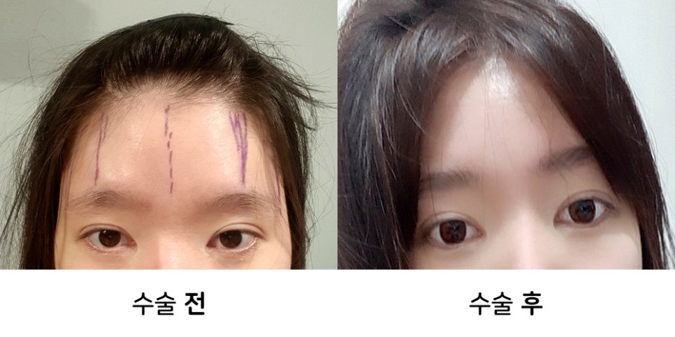 내시경이마거상술 붓기와 회복기간, 후기사진과 함께 알아보기 관련 이미지 5