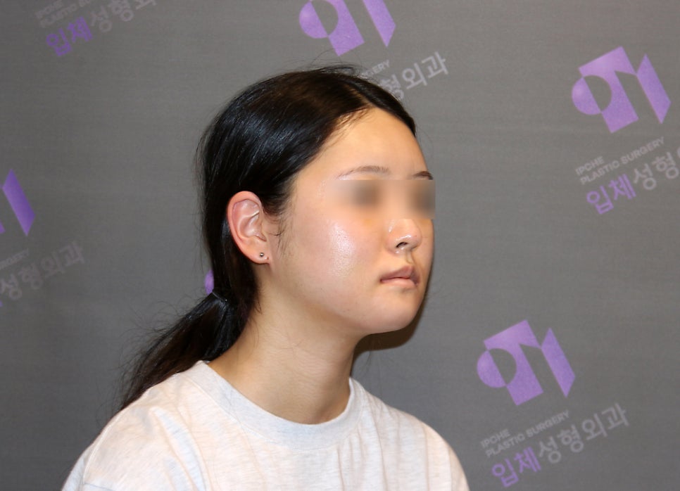 안면윤곽수술 후 붓기, 일차별(1일~30일차) 사진과 함께 회복기간 알아보기 관련 이미지 4