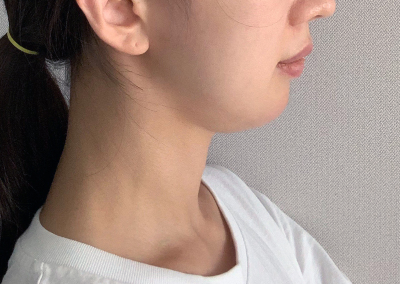 What Side Effects Can Occur After Chin Surgery? image 2
