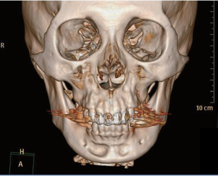 Does chin filler or an implant cause bone erosion? image 1