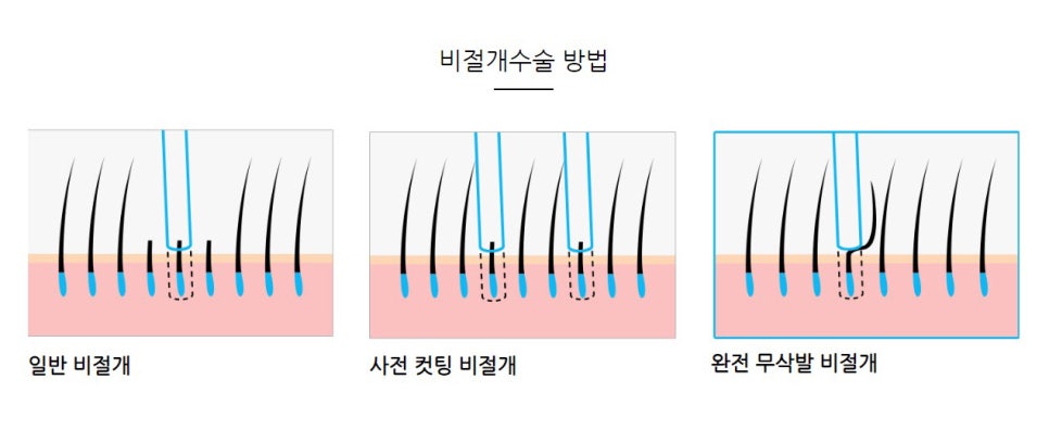 얼굴비율에 맞지 않는 넓은 이마는 어떻게 해결해야 할까요? 관련 이미지 3