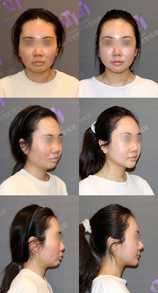 턱끝수술 종류 총정리, 전진술부터 뼈이식까지 관련 이미지 13