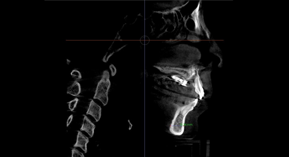 What Surgery Is Best for Correcting a Recessed Chin? The Limits of Chin Advancement Surgery and the Actual Results image 9