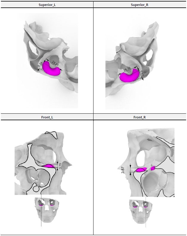 What Is the Best Way to Correct Deep-Set Eyes? image 4