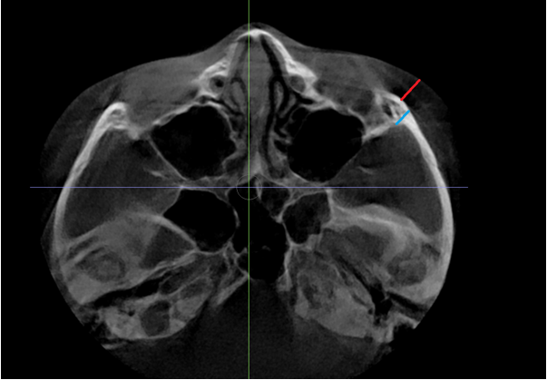 Why Cheekbones Show When You Smile, and Why Cheekbone Surgery May Not Help - Explained by a Specialist image 3