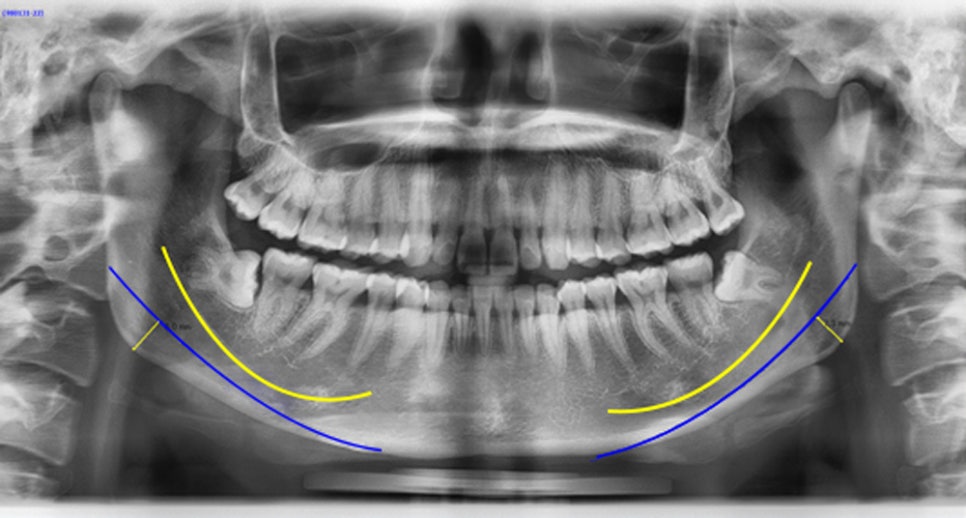 What Should Be the Top Priority in Facial Contouring Surgery: Effectiveness or Safety? image 3