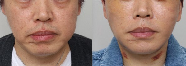 Amazing Changes Achieved with Contouring Facelift: A Facelift Technique That Even Addresses Asymmetry image 6
