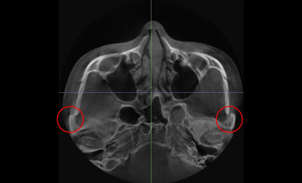 Does the Surgical Method Change Depending on the Protruding Cheekbone Location? Exact Locations and Diagnosis of the Front Cheekbone, Side Cheekbone, 45-Degree Cheekbone, and Back Cheekbone image 6