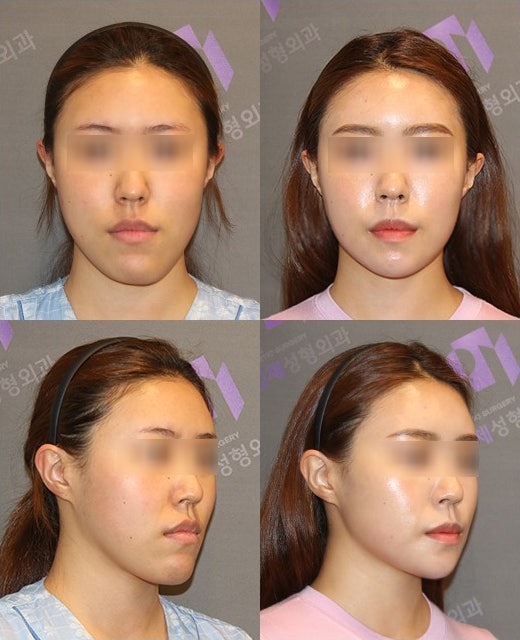 Which Surgery Do I Need: Contouring Surgery or Double-Jaw Surgery? image 7