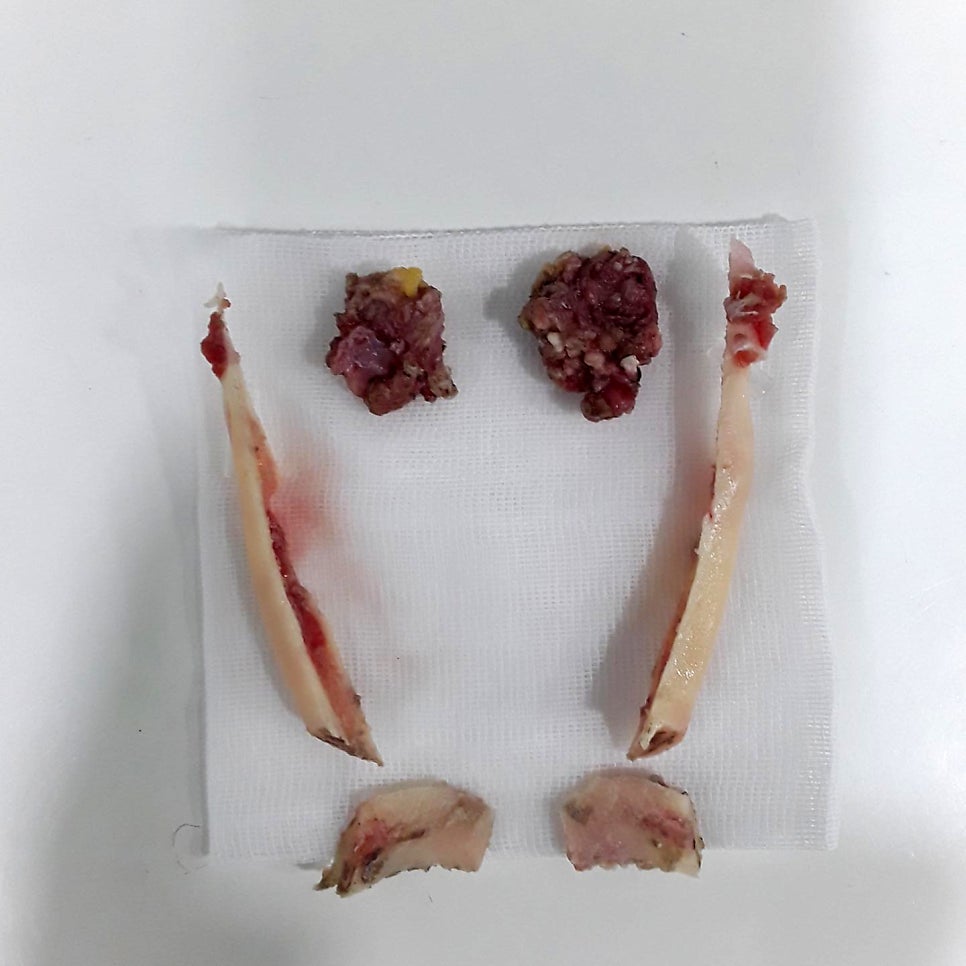 Is masseter muscle resection really necessary for square jaw reduction? image 2