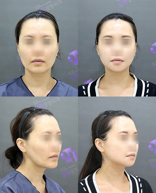 What Are the Features of a Youthful Face? Why Does a Small Chin Make a Face Look Younger? image 3