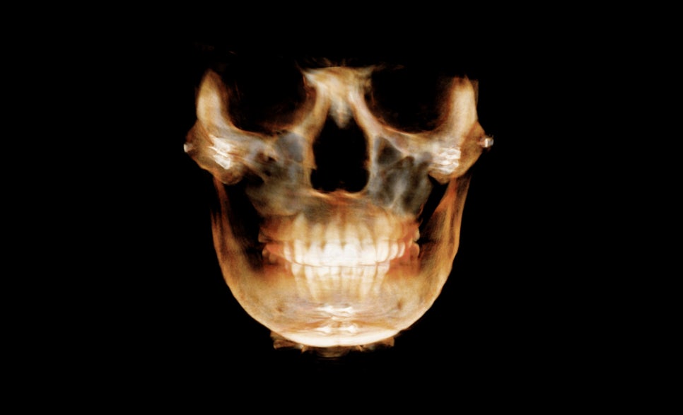 Is It Necessary to Remove the Fixation Pins After Facial Contouring Surgery? image 1
