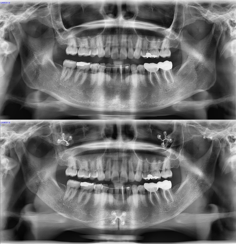 What Side Effects Can Occur After Chin Surgery? image 6