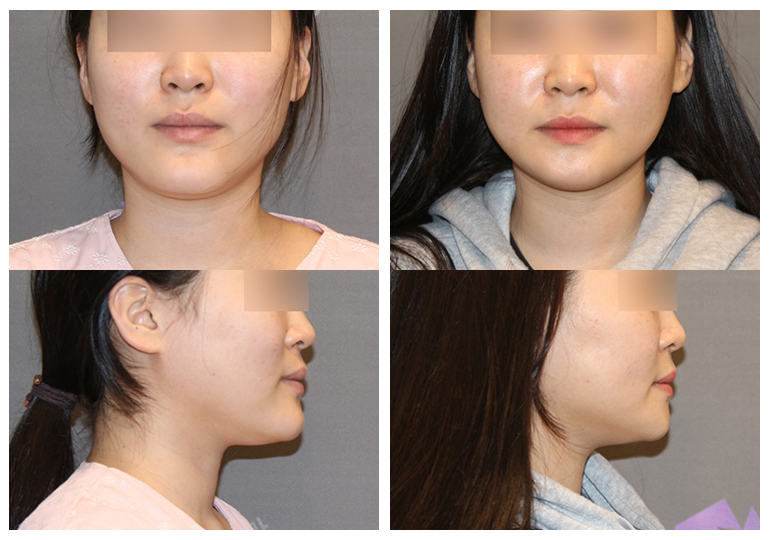 Why Are There So Many Different Chin Surgery Methods? Exploring Advancement, Setback, Reduction, and Lengthening image 2