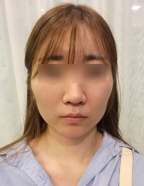 땅콩형얼굴 윤곽수술로 해결할 수 있을까요? 관련 이미지 1