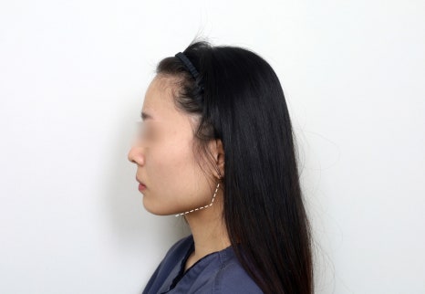 귀밑턱은 왜 중요할까? 안면윤곽수술에서 놓치기 쉬운 얼굴형의 핵심 관련 이미지 1