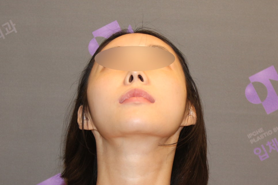 Lateral Cheekbone Reduction Surgery Review: Looking at Real Cases image 3