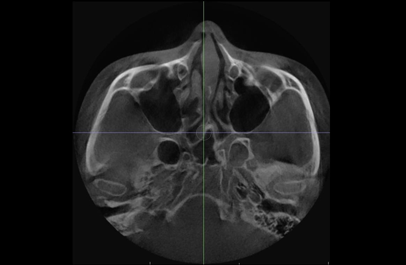 Will cheekbone reduction surgery also make the face smaller? : Learn about how to reduce prominent cheekbones with real surgical cases image 8