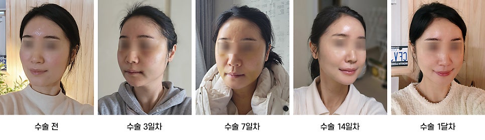 안면윤곽 수술 후 붓기, 일상생활은 언제부터 가능한가요? 케이스별로 알아보기 관련 이미지 9