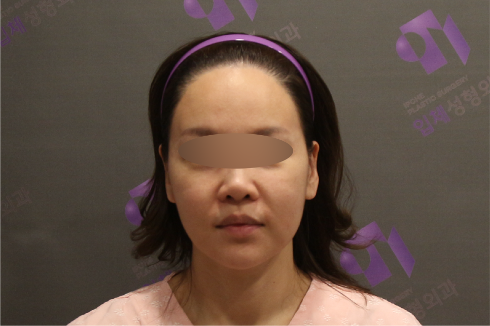 안면윤곽 볼처짐100%온다? 광대수술 부작용 총정리 | 上편 관련 이미지 1