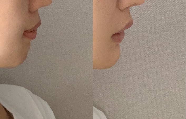 턱보조개, 갈라진턱, 엉덩이턱은 어떻게 해결해야 할까요? 관련 이미지 14