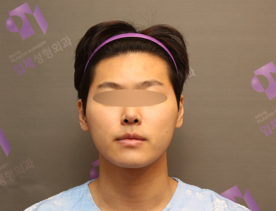 Male Cheekbone Reduction Surgery, Explained with Before-and-After Photos of Facial Contouring Surgery. image 1