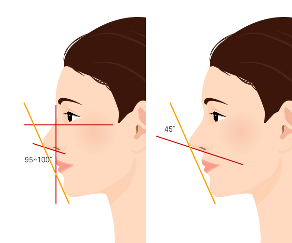 돌출입과 무턱은 윤곽수술로 교정이 가능할까요? 관련 이미지 1