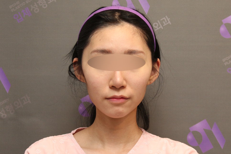45-Degree Cheekbone Reduction Surgery Review, Let’s Look at Cases Together - Information from a Specialist image 1