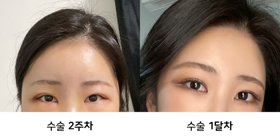 내시경이마거상술 붓기와 회복기간, 후기사진과 함께 알아보기 관련 이미지 2