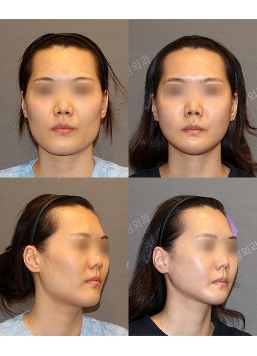 여름철 안면윤곽수술 계절의 영향을 받을까요? 관련 이미지 1