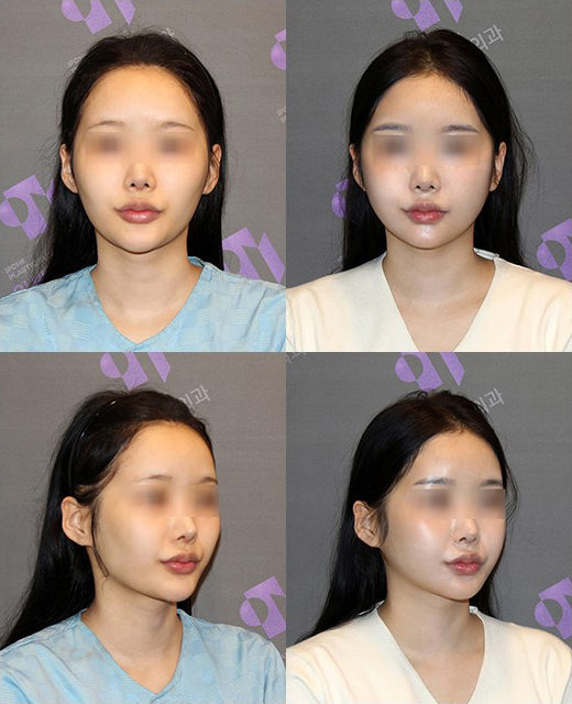땅콩형 얼굴, 안면윤곽 수술로 해결할 수 있을까요? 관련 이미지 5