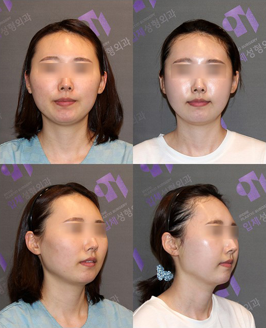 땅콩형얼굴 윤곽수술로 해결할 수 있을까요? 관련 이미지 4