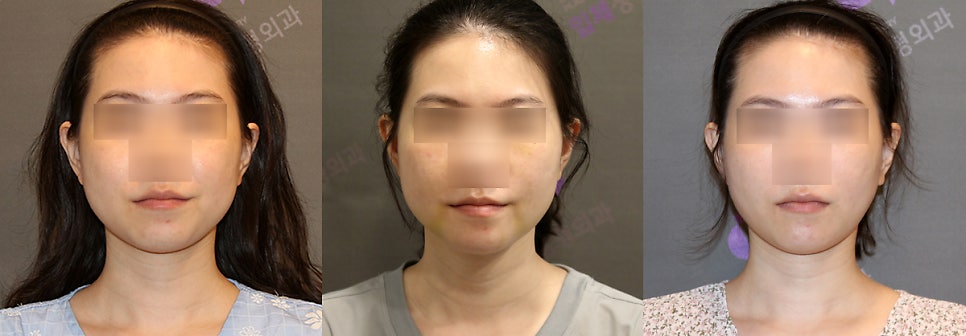 Is Pin Removal Surgery Necessary After Facial Contouring? What About Swelling and Recovery Time? image 6