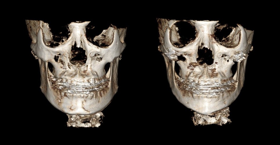 Is Pin Removal Surgery Necessary in Facial Contouring? Titanium Fixation Pins vs. Absorbable Fixation Pins image 3